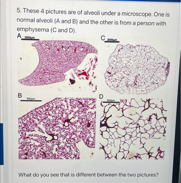 5. These 4 pictures are of alveoli under a microscope. One is
normal alveoli (A and B) and the other is from a person with
em