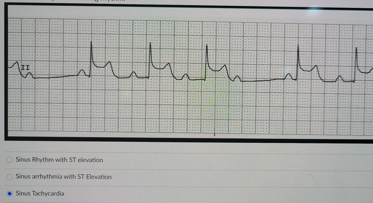Solved ا ا ا ا ا II Sinus Rhythm with ST elevation Sinus | Chegg.com