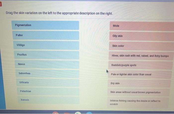 Drag the skin variation on the left to the appropriate description on the right. Pigmentation Mole Pallor Oily skin Vitiligo