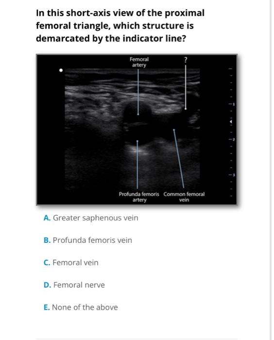 In this short-axis view of the proximal
femoral triangle, which structure is
demarcated by the indicator line?
Femoral
artery