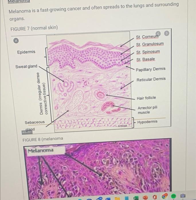Mela
Melanoma is a fast-growing cancer and often spreads to the lungs and surrounding
organs.
FIGURE 7 (normal skin)
St. Corn