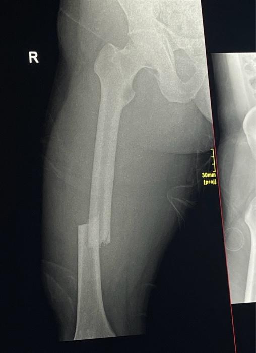 Solved Case presentation of mid femoral shaft fracture with | Chegg.com