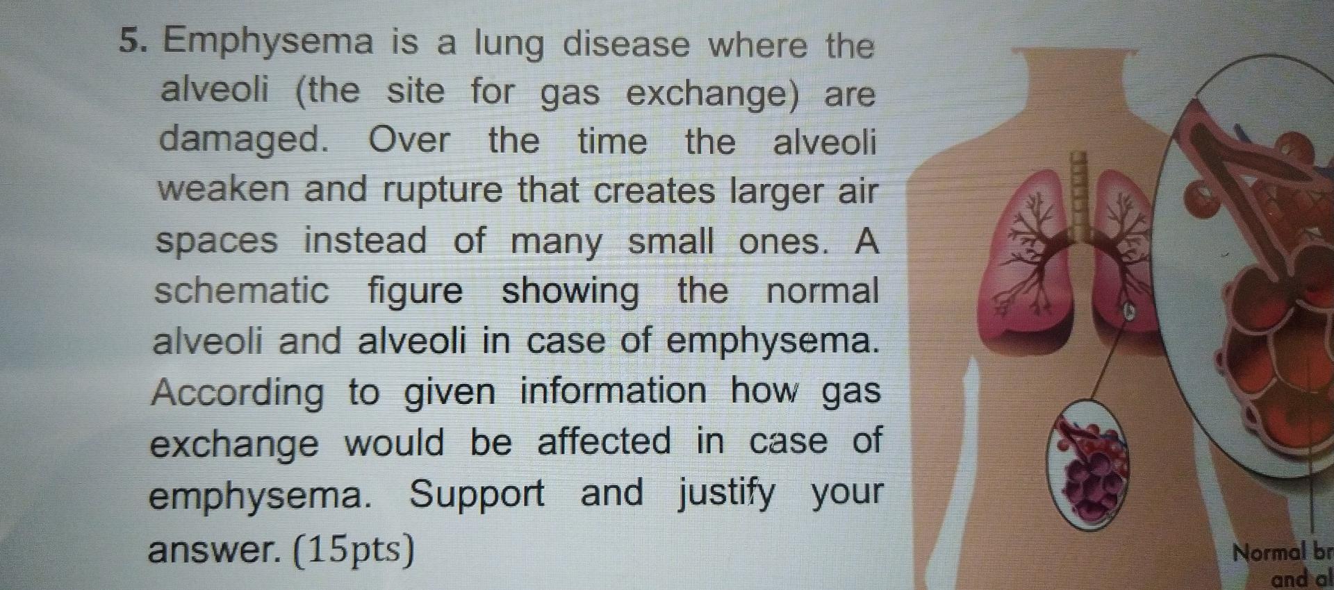 5. Emphysema is a lung disease where the alveoli (the site for gas exchange) are damaged. Over the time the alveoli weaken an