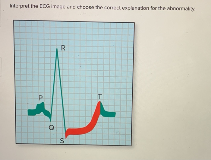 Solved Interpret the ECG image and choose the correct | Chegg.com