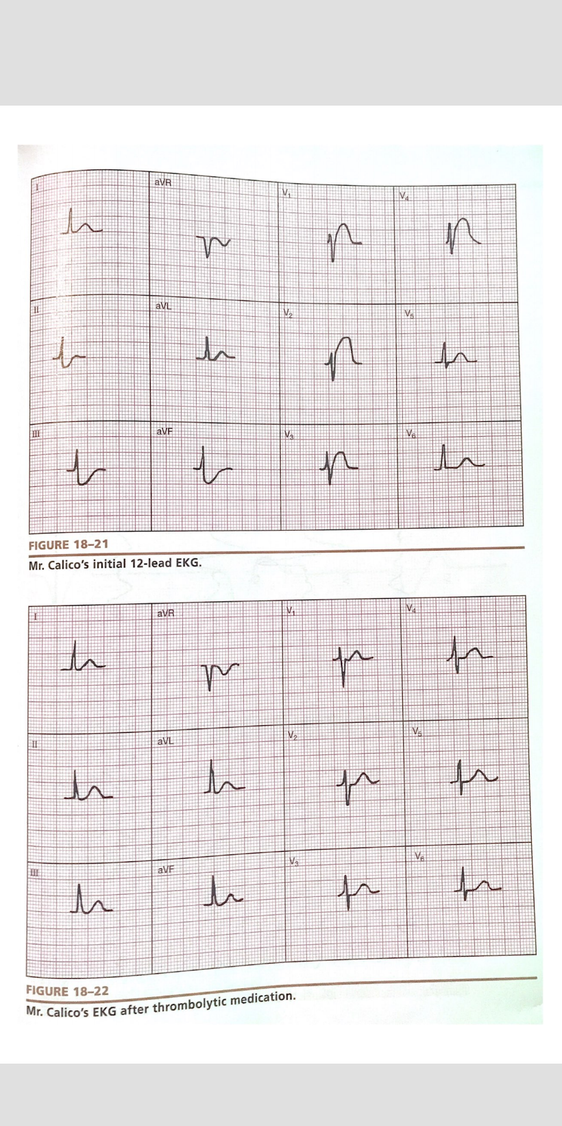 AVR 1 Va { M M . avi . E AVE IV VA 1 루 FIGURE 18-21 Mr. Calicos initial 12-lead EKG. AVR VA VE 3 커 도 IV V. av! th 국 루 로 VA H