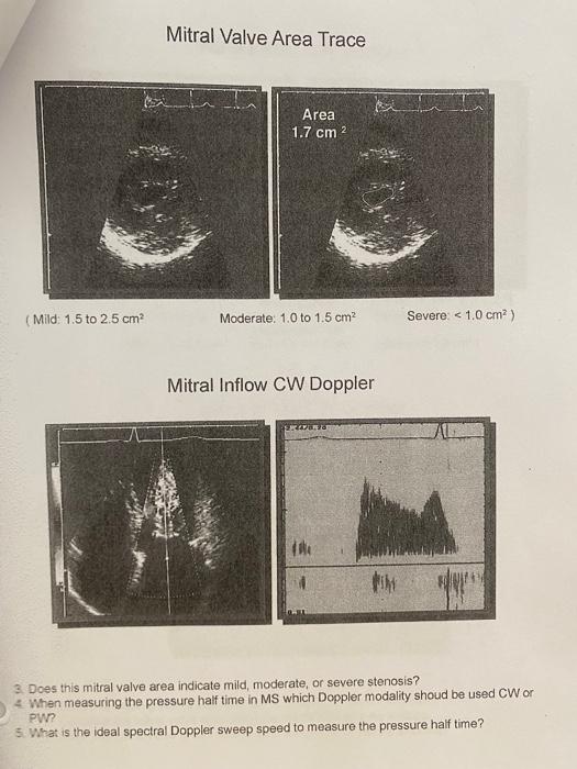 Mitral Valve Area Trace
Mitral Inflow CW Doppler
3. Does this mitral valve area indicate mild, moderate, or severe stenosis?
