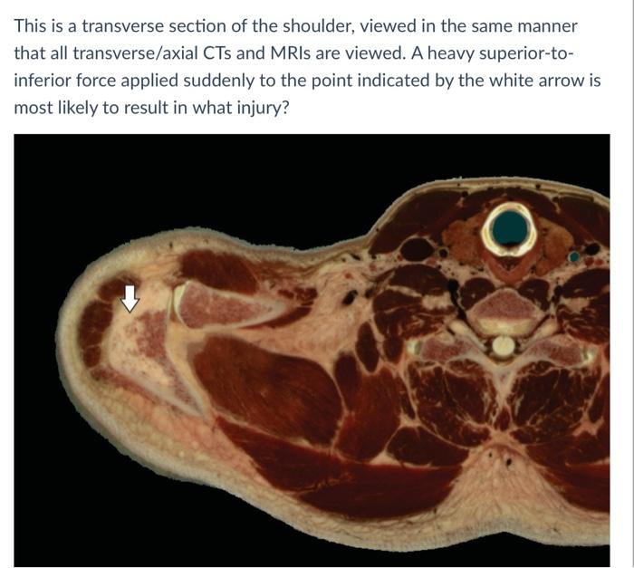 This is a transverse section of the shoulder, viewed in the same manner that all transverse/axial CTs and MRIs are viewed. A 