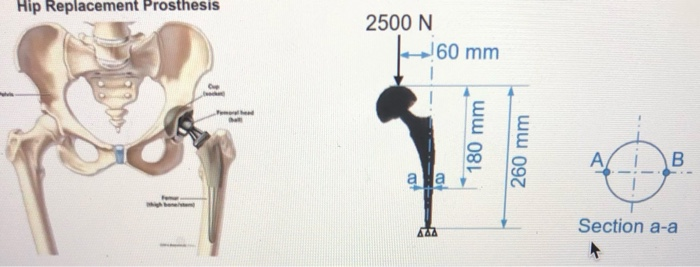 Solved Hip Replacement Prosthesis 2500 N 60 160 mm 180 mm | Chegg.com