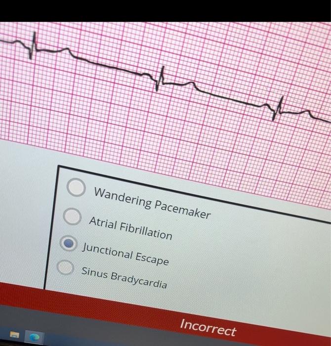 Solved Sinus Rhythm with 1st Degree AV Block 2nd Degree Type | Chegg.com