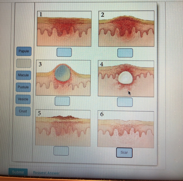 macule vs papule