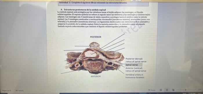 Actividad Soptiplau colocando las estruturas faltek A Fractures protectoras de la modula espinal La mula espinal i protegida