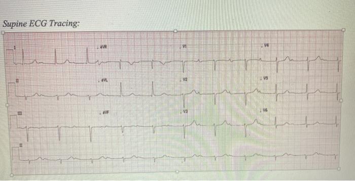Solved Measure PR and QRS intervals in lead II and classify | Chegg.com