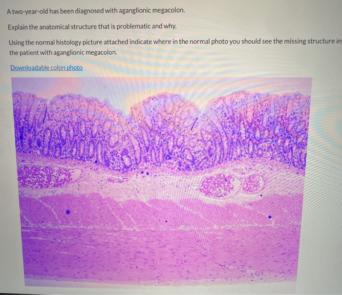 Solved A two-year-old has been diagnosed with aganglionic | Chegg.com