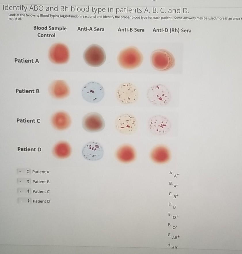 solved-identify-abo-and-rh-blood-type-in-patients-a-b-c-chegg