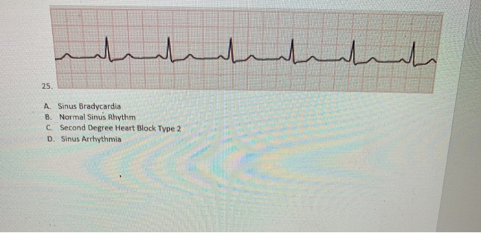 Solved A Sinus Bradycardia B Normal Sinus Rhythm C Sec Chegg Com