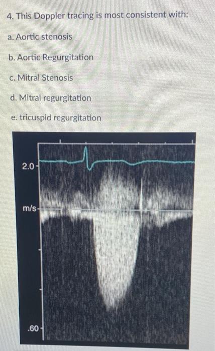 4. This Doppler tracing is most consistent with:
a. Aortic stenosis
b. Aortic Regurgitation
c. Mitral Stenosis
d. Mitral regu