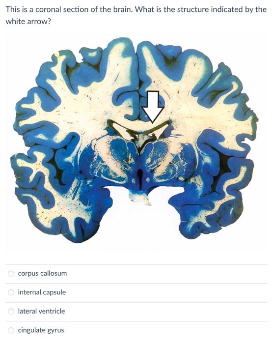 This is a coronal section of the brain. What is the structure indicated by the white arrow?
corpus callosum
internal capsule
