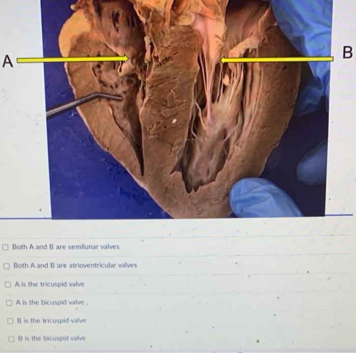 Both \( A \) and \( B \) are semilunar valves
Both \( A \) and \( B \) are atrioventricular valves
A is the tricuspid valve
\