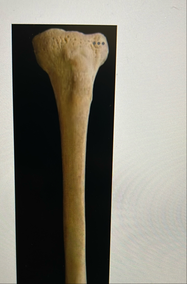 Solved 1A tibial tuberosity(B) ﻿fibular projection(C) | Chegg.com