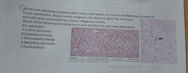 Solved A 50-year-old woman presents with a lump in her | Chegg.com