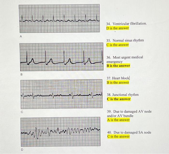 Solved 34. Ventricular fibrillation. D is the answer A 35. | Chegg.com