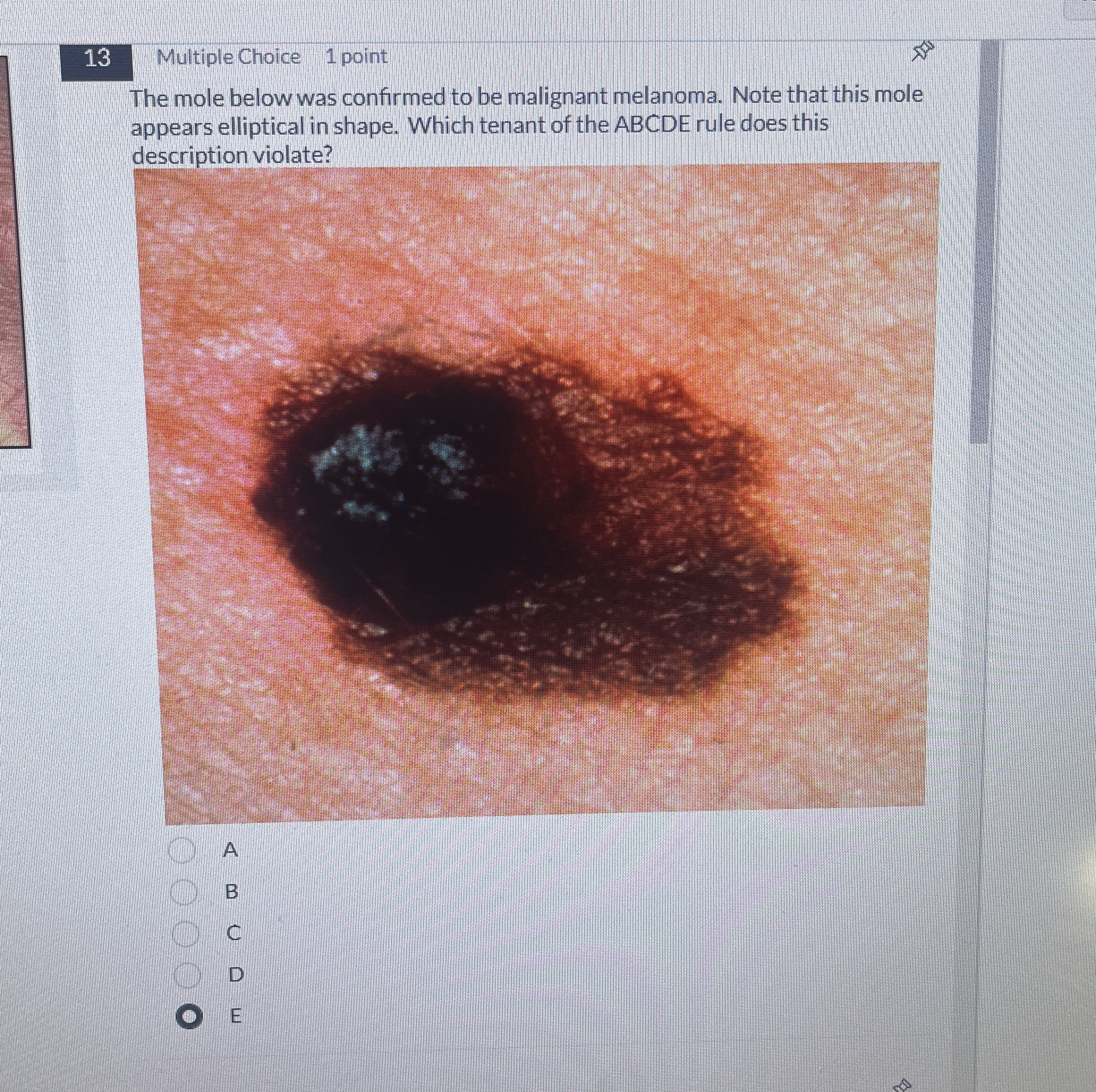 Solved The mole below was confirmed to be melanoma. Note | Chegg.com