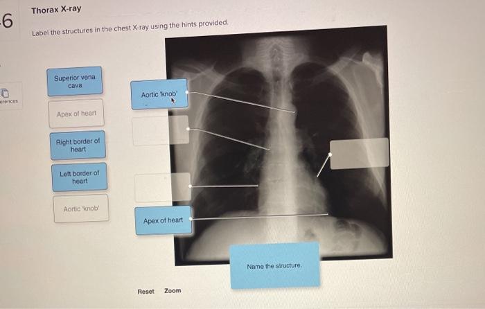 35 Chest X Ray Label Labels 2021