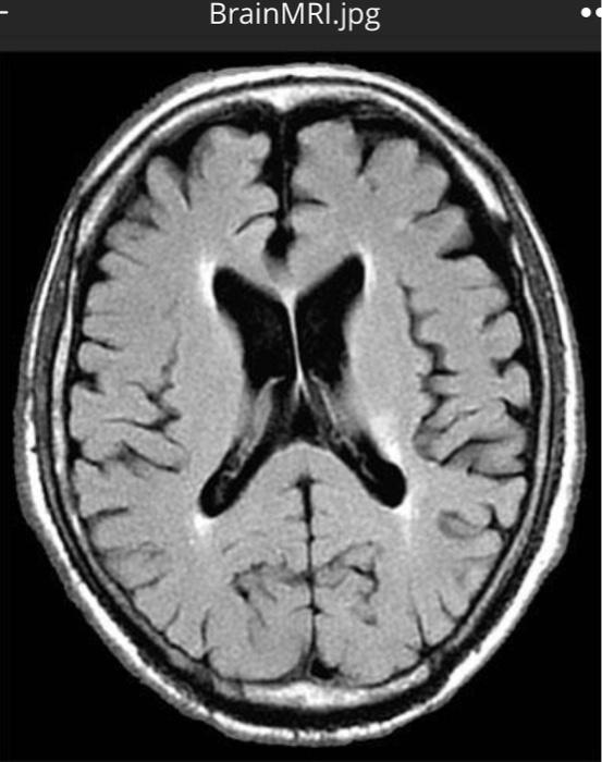 Solved 4. Use the files named Brain MRI.jpg and Brain Cancer | Chegg.com