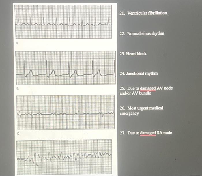 Solved A 21. Ventricular fibrillation. 22. Normal sinus | Chegg.com