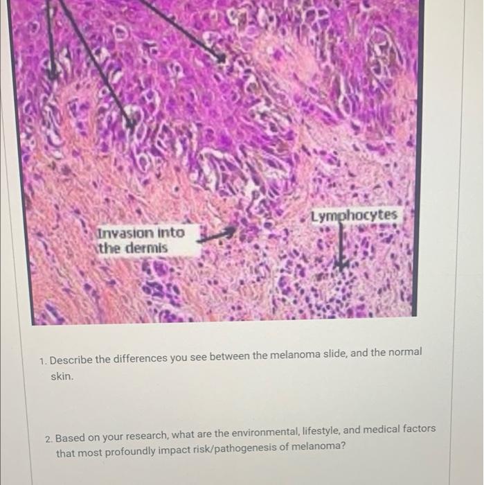Lymphocytes
Invasion into
the dermis
1. Describe the differences you see between the melanoma slide, and the normal
skin.
2. 