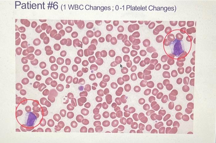 Solved Patient \#6 (1 WBC changes; 0-1 Plt changes) Age: 20 | Chegg.com