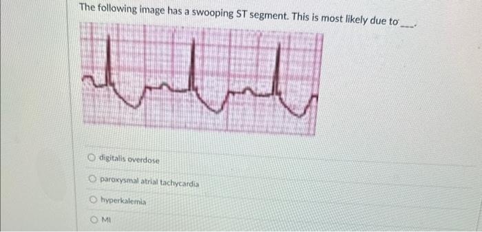 The following image has a swooping ST segment. This is most likely due to
digitalis overdose
paroxysmal atrial tachycardia
hy