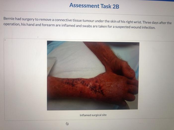 Assessment Task 2B Bernie had surgery to remove a connective tissue tumour under the skin of his right wrist. Three days afte