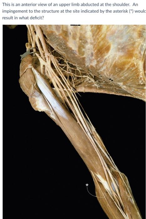 This is an anterior view of an upper limb abducted at the shoulder. An impingement to the structure at the site indicated by 