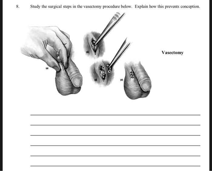 Vasectomy Definition, Procedure & Effects - Lesson