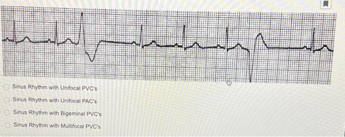 Solved 2nd Degree Heart Block Type 1 Sinus Bradycardia | Chegg.com