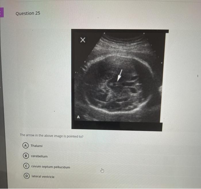 Question 25 х The arrow in the above image is pointed to? Thalami B cerebellum cavum septum pellucidum 5 lateral ventricle