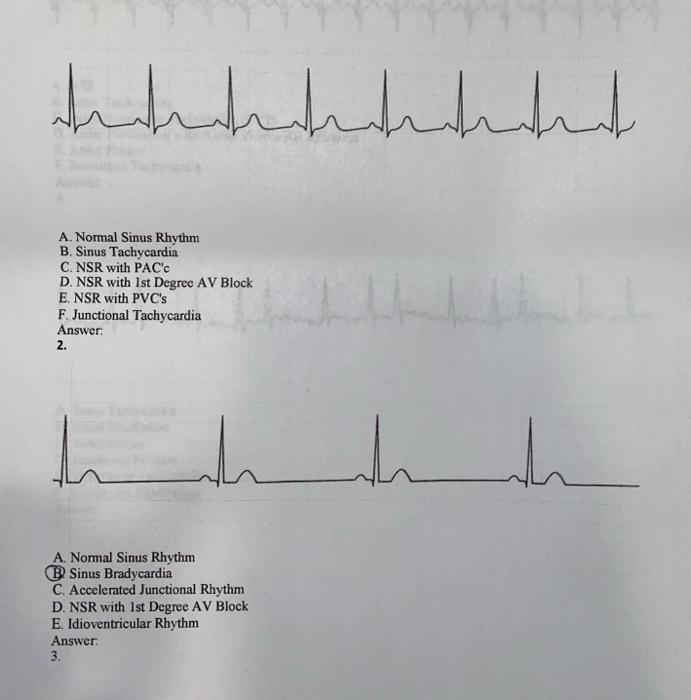 Antrentranth A Normal Sinus Rhythm B Sinus Chegg Com