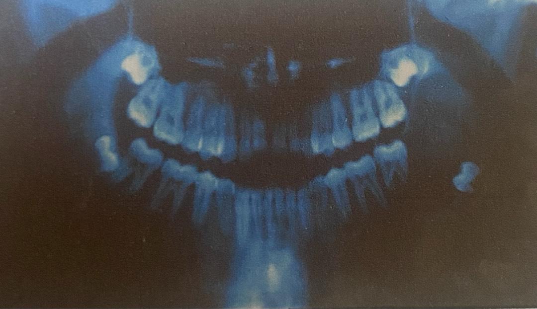 cheratocisti odontogena