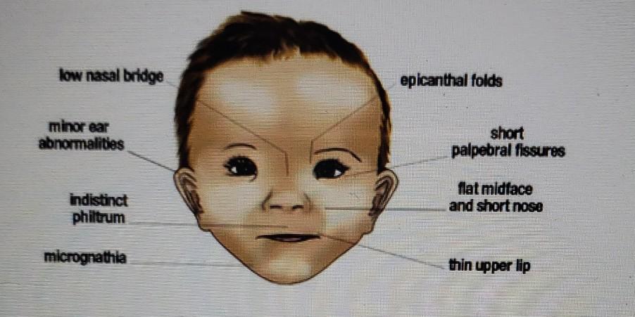 Solved a) Case #1 A baby is admitted to the NICU following | Chegg.com