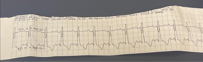 Solved Please Interpret This Ekg, The Cause And The | Chegg.com