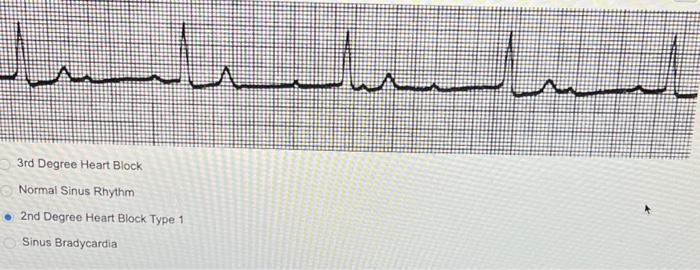 Solved 2nd Degree Heart Block Type II Sinus Rhythm with PJC | Chegg.com