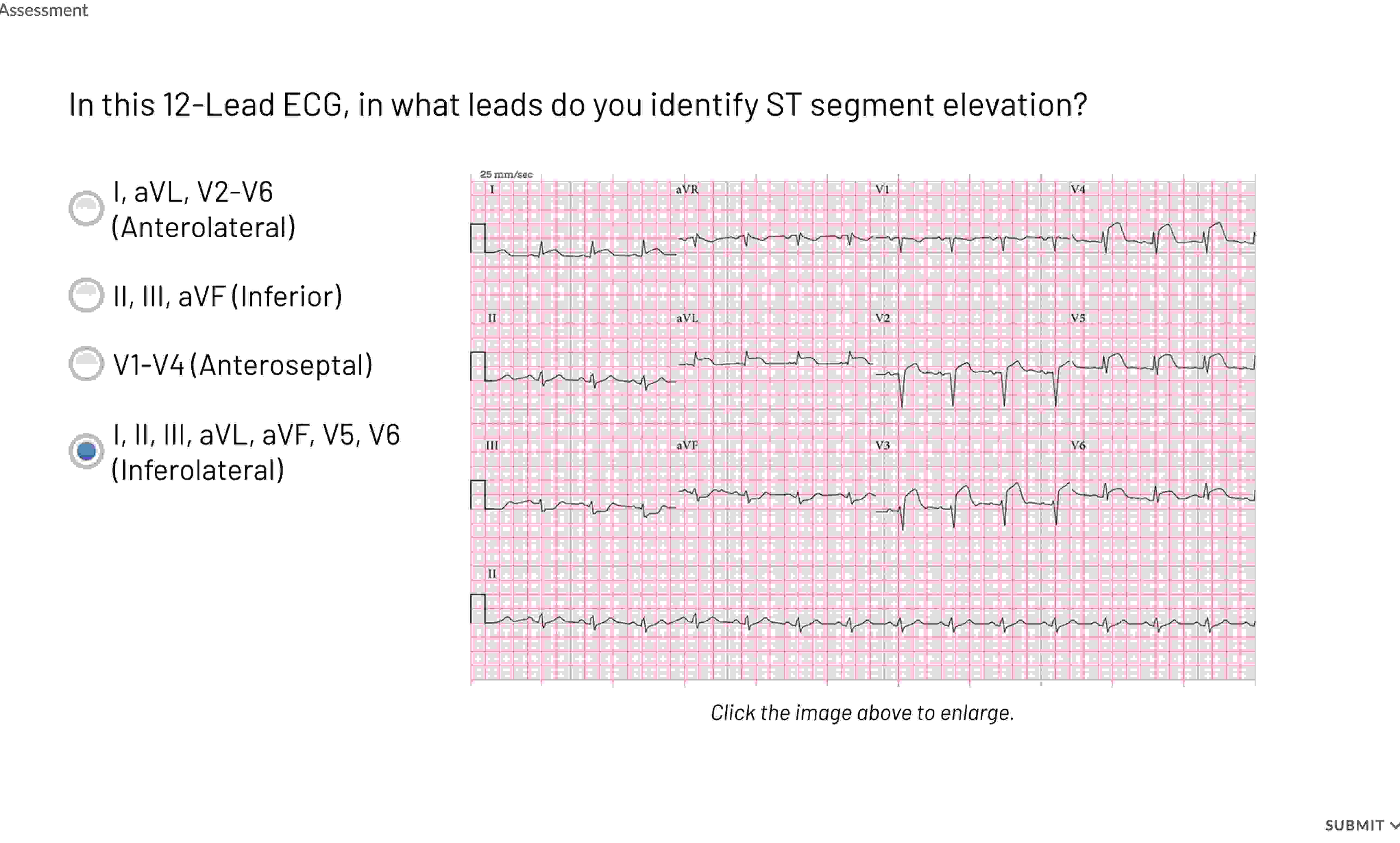 Solved Assessmentin This 12-lead Ecg, In What Leads Do You 