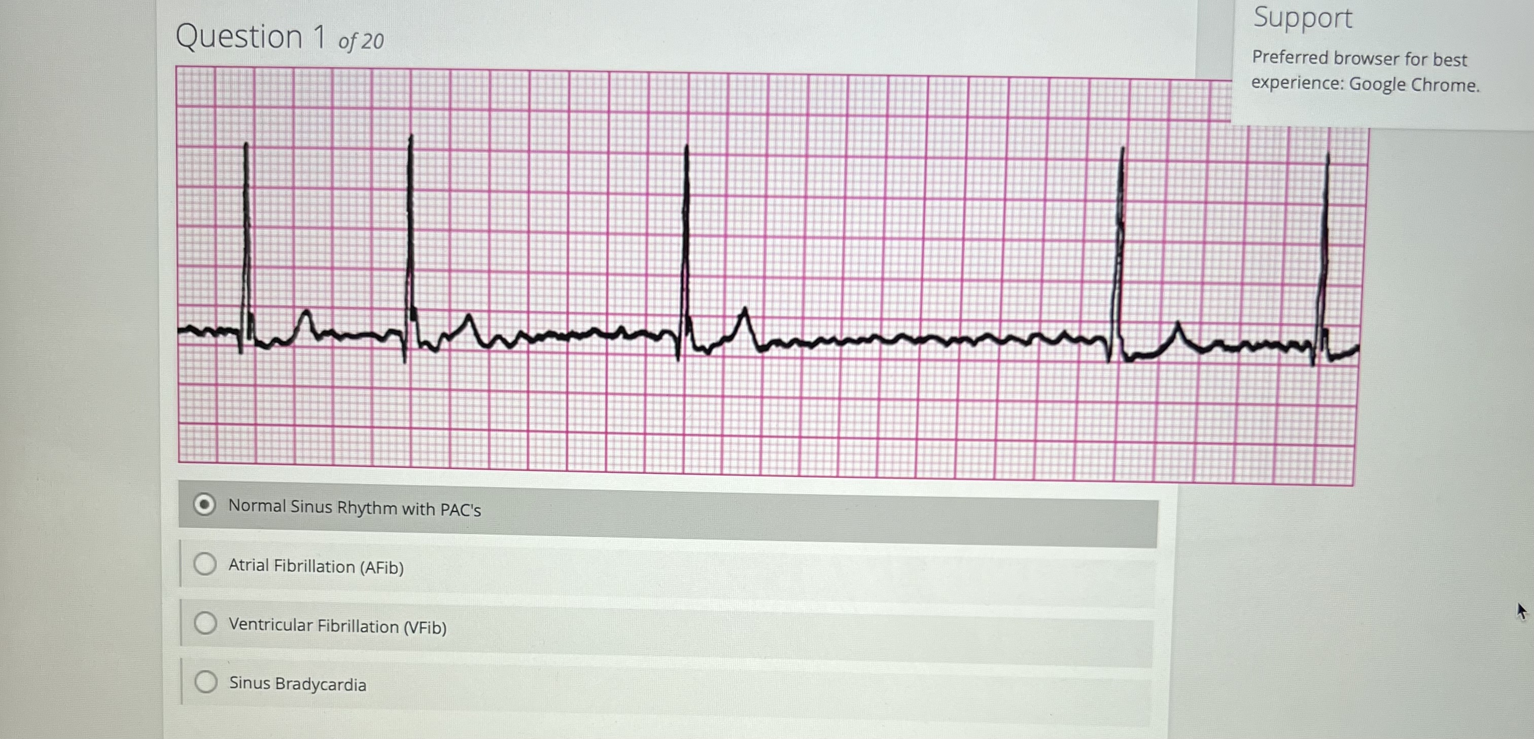 Solved Question 1 ﻿of 20Normal Sinus Rhythm with PAC'sAtrial | Chegg.com