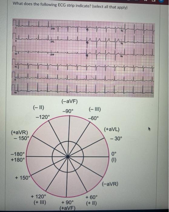 What does the following ECG strip indicate? (select all that apply)