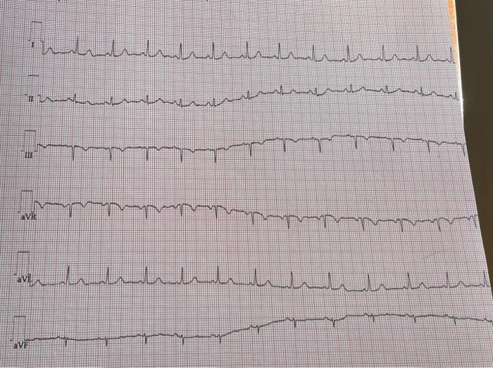 Solved Can you help me label this ECG? it needs the P wave, | Chegg.com