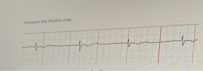 Interpret this rhythm strip | Chegg.com