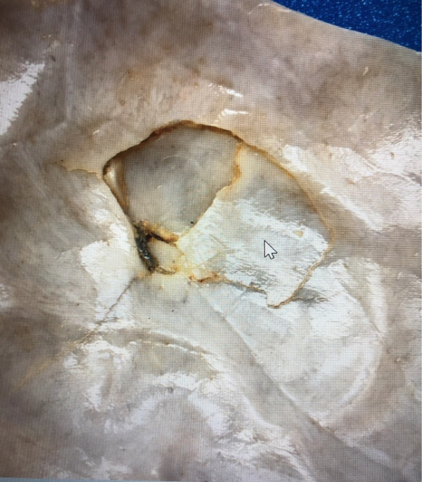 Sharp Force Trauma Radiograph Solved is this sharp force trauma or blunt force trauma? and | Chegg.com