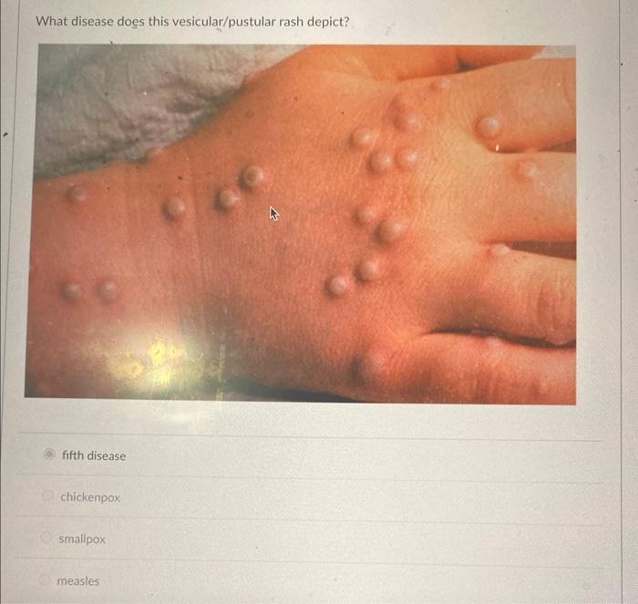 Solved What disease does this vesicular/pustular rash | Chegg.com