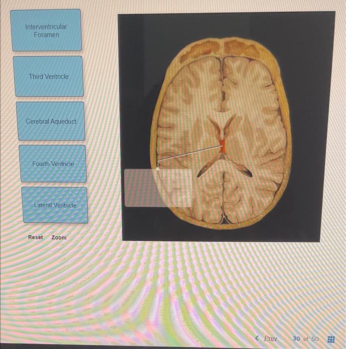 Interventricular
Foramen
Third Ventricle
Cerebral Aqueduct
Fourth Ventricle
Lateral Ventricle
Reset Zoom
Prev
30 of 50